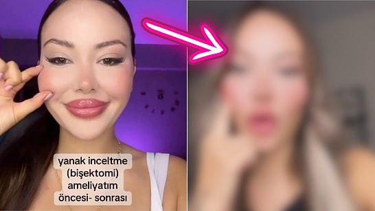 A Woman Who Underwent Cheek Slimming Surgery Shares Her Transformation