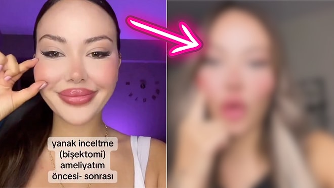 A Woman Who Underwent Cheek Slimming Surgery Shares Her Transformation