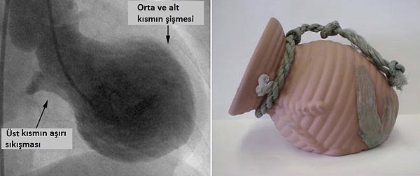 Takotsubo Kardiyomiyopatisi Nedir, Halk Arasında Bilinen Adı Ne?