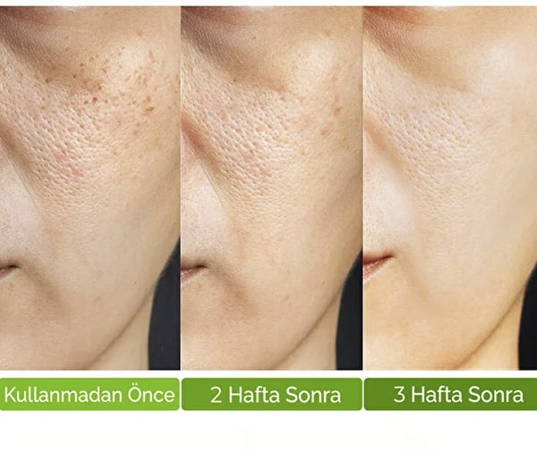 Siyah noktaya çalışan, gözenekleri toplayan, fazla yağı dengeleyen: DEVIDA Siyah Nokta Gözenek Sıkılaştırıcı Vivo Series A210