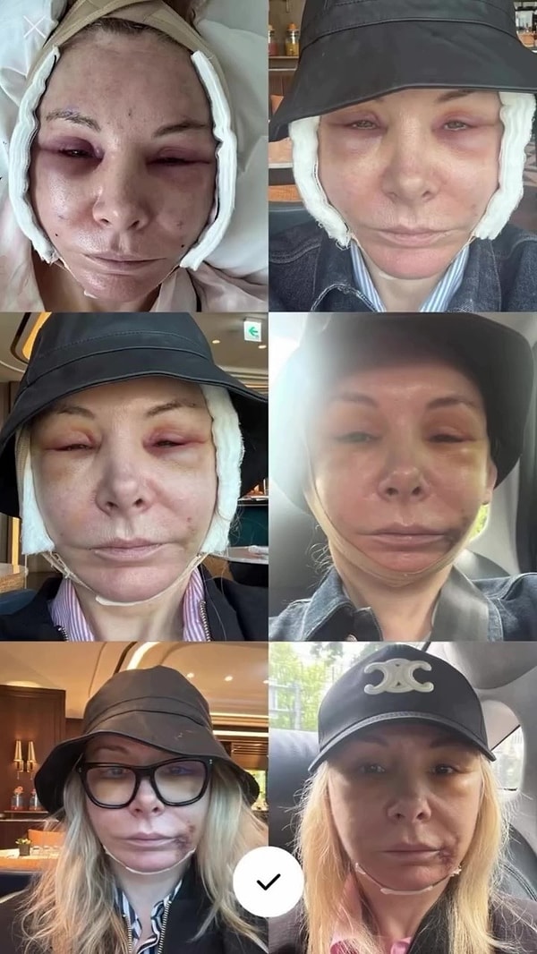 Seul’deki bir estetik hastanesinin cerrahını seçmeden önce birçok doktorla görüştü ve ameliyat için toplam 20 bin sterlin ödedi.