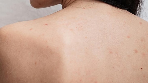 4. Sırtında çıkan pürüzler için önlemin ne?