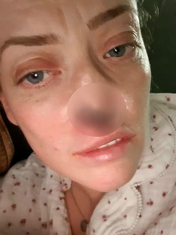 İki çocuk annesi Leanne, İngiltere’de yaklaşık 50 bin sterlin istenen tedavi için Antalya’ya geldi.