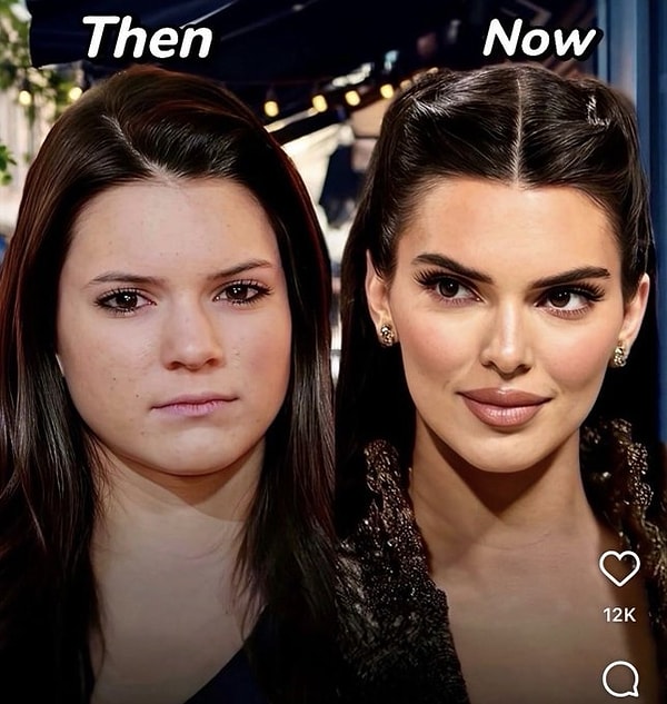 Dünyanın en çok konuşulan isimlerinden biri olan Kendall Jenner, yıllardır hakkında bitmeyen estetik iddialarıyla gündemde.