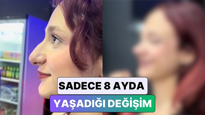 Burun Estetiği Yaptıran Bir Kadın Yaşadığı Değişimi Paylaştı