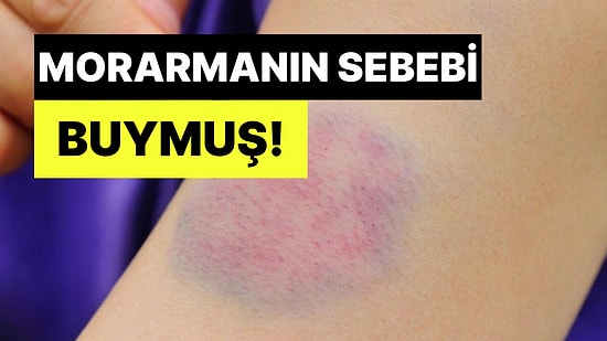 Uzmanlar Cildin Kolayca Morarmasının Sebebini Açıkladı