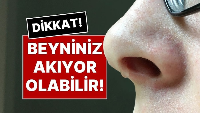 Geçmeyen Burun Akıntısının Nedeni Nedir? Beyin Sıvınız Akıyor Olabilir!