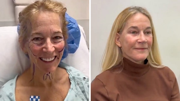 Son yıllarda sosyal medyada estetik yaptıran kişilerin önceki ve sonraki hallerini sık sık görür olduk.