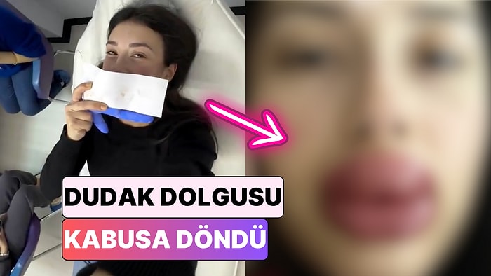 Yeni Fobi Oluştu: Dudak Dolgusu Yaptıran Bir Kadın Dudaklarının Geldiği Hali Paylaştı