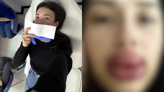 New Fear Unlocked: Woman Shares Shocking Results of Her Lip Filler Gone Wrong