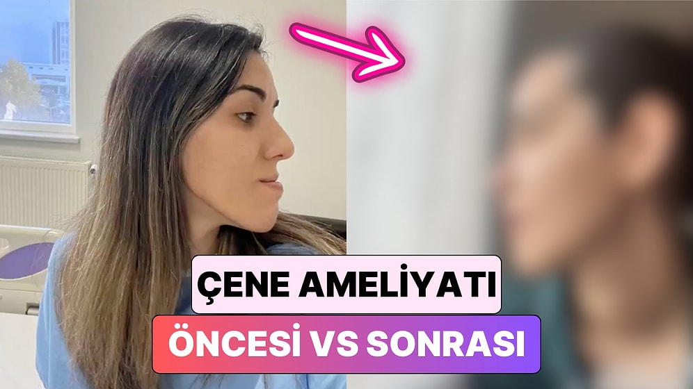 Çift Çene Ameliyatı Olan Bir Kadın Günler İçinde Yaşadığı Değişimi Paylaştı