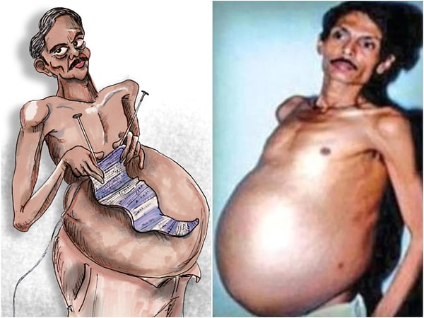 Yıllar boyunca fark edilen şişlik, hayatın parçası haline geldi