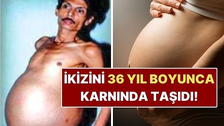 İkiz Kardeşini 36 Yıl Boyunca Karnında Taşıyan Adam: Tıp Tarihine Geçti!