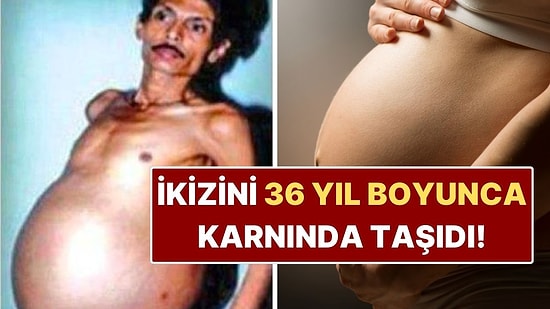 İkiz Kardeşini 36 Yıl Boyunca Karnında Taşıyan Adam: Tıp Tarihine Geçti!
