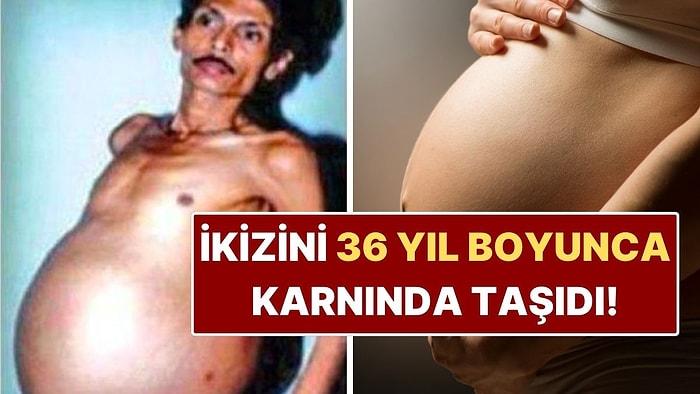İkiz Kardeşini 36 Yıl Boyunca Karnında Taşıyan Adam: Tıp Tarihine Geçti!
