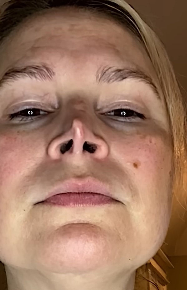 ABD’nin Texas eyaletinde yaşayan Holly adlı kadın, geçirdiği başarısız burun estetiği operasyonu sonrası görünümünün tamamen değiştiğini söyleyerek yaşadıklarını anlattı.