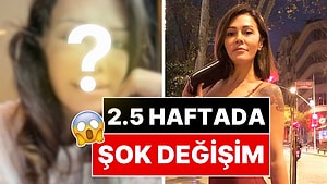 Yüz Nakli Yaptıran Didem Ceran, Yüzünün 21 Gün Sonra Geldiği Hali Paylaştı!
