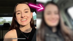 From Braces to Jaw Surgery: A Woman’s Incredible Transformation Journey and How It Changed Her Life Forever