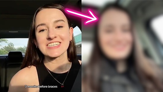 From Braces to Jaw Surgery: A Woman’s Incredible Transformation Journey and How It Changed Her Life Forever