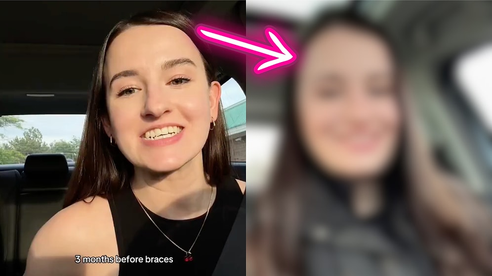 From Braces to Jaw Surgery: A Woman’s Incredible Transformation Journey and How It Changed Her Life Forever