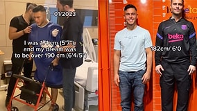 A Man Shares His Full Journey Through Limb Lengthening Surgery: Challenges, Recovery, and the Final Results