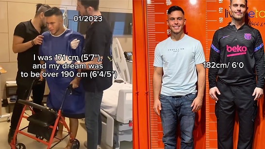 A Man Shares His Full Journey Through Limb Lengthening Surgery: Challenges, Recovery, and the Final Results
