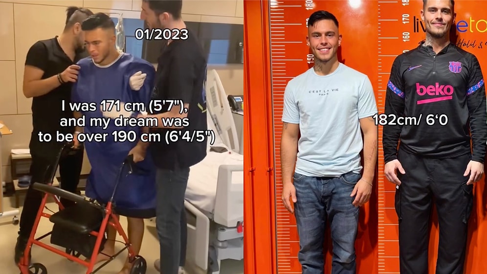 A Man Shares His Full Journey Through Limb Lengthening Surgery: Challenges, Recovery, and the Final Results