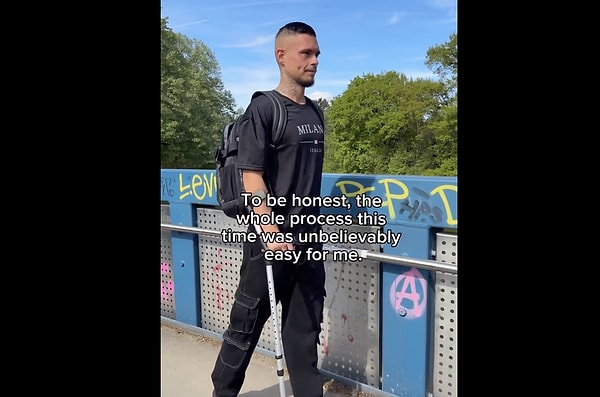 Initially, he underwent surgery on his femur at the start of 2023, followed by another operation on his lower leg bone in 2025. As a result, he grew approximately 20 cm, stretching from 171 cm to 191 cm in height.