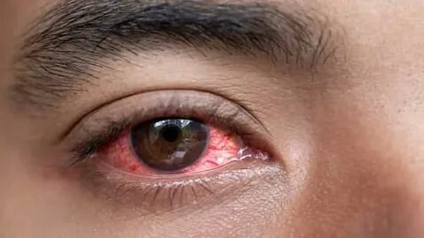 2. Gözleriniz sanki bütün gece ağlamışsınız gibi kan çanağına döner.