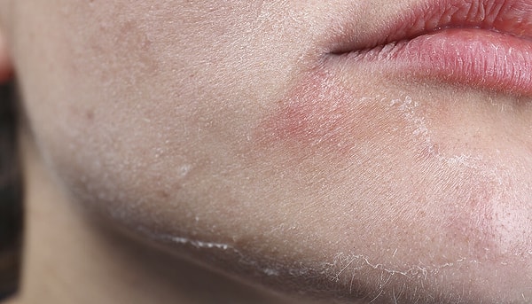 5. Cildiniz kurumaya başlar.