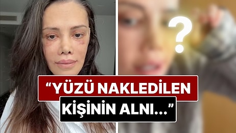 Yüz Nakli Geçiren Didem Ceran'ın Yüzündeki Komplikasyon Şaşırttı!