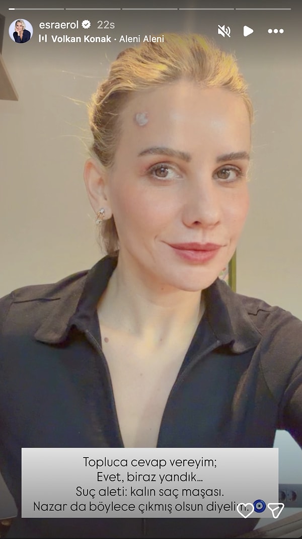 Esra Erol, canlı yayın öncesinde alnını yaktığını açıkladı.