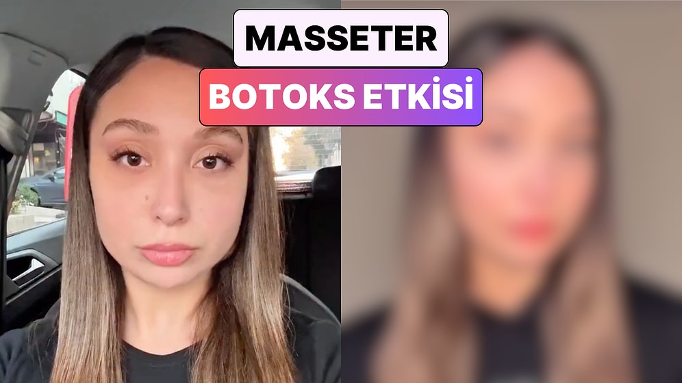 Bir Kadın Masseter Botoksu Yaptırdıktan Sonra Yaşadığı Değişimi Paylaştı