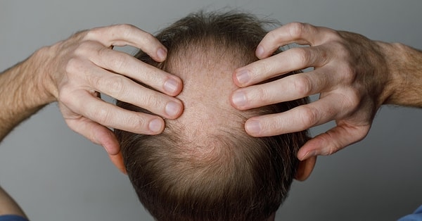 Yıllardır denenen yöntemler vardı ama saç kökleri gerçek saç gibi davranmıyordu.