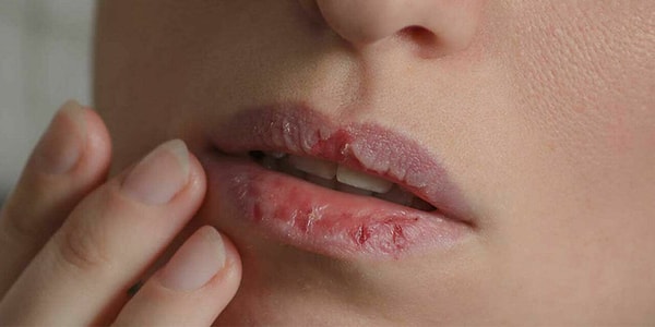 Dudak yeme alışkanlığı çoğu zaman stresin dışa vurumu olarak görülüyor