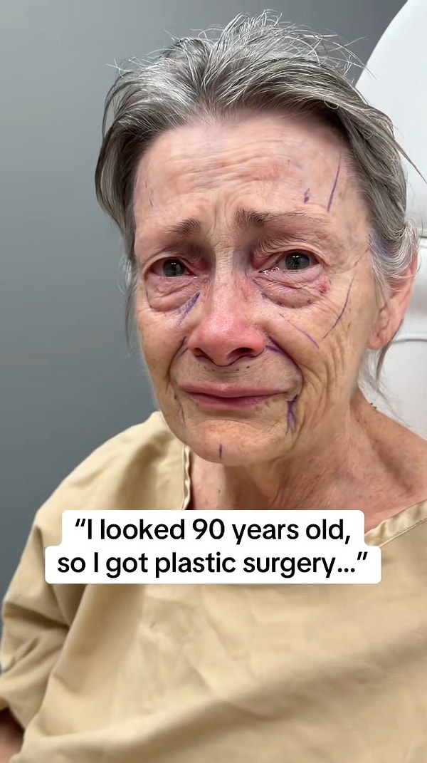 Beverly Hills’te görev yapan Dr. Carl Truesdale’in gerçekleştirdiği bir yüz germe operasyonu, 70 yaşındaki bir kadının adeta zamanın gerisine gidermiş gibi gençleşmesini sağladı.