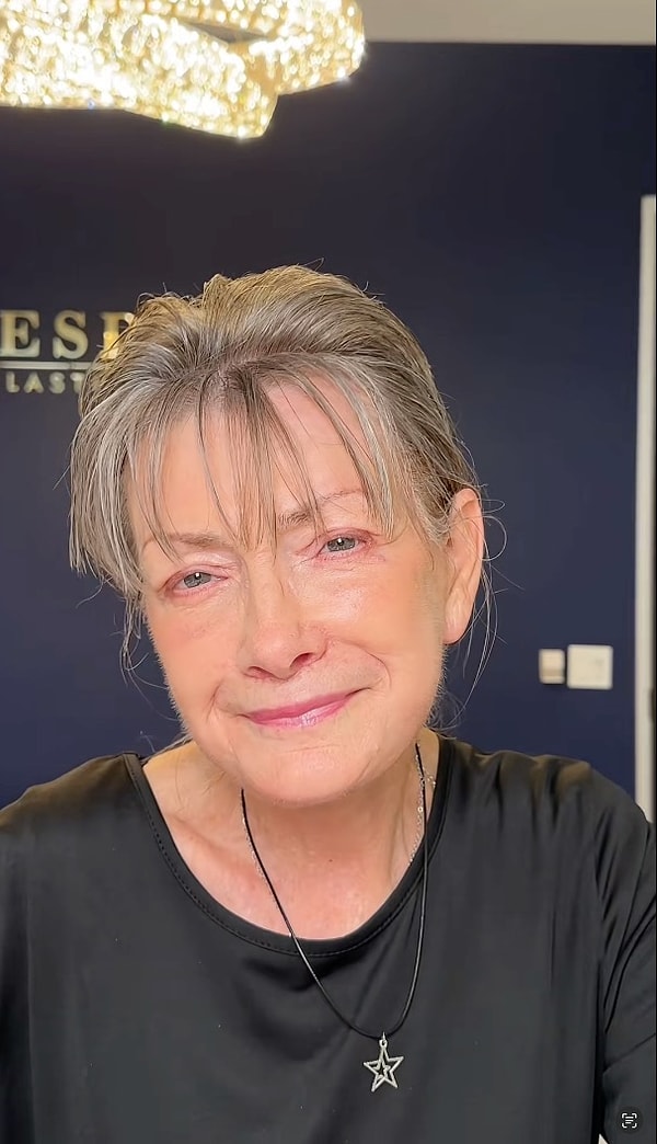 Ameliyat sonrası görüntülerde, kadının cildi daha parlak ve sağlıklı, kırışıklıkları ise belirgin şekilde azalmıştı.