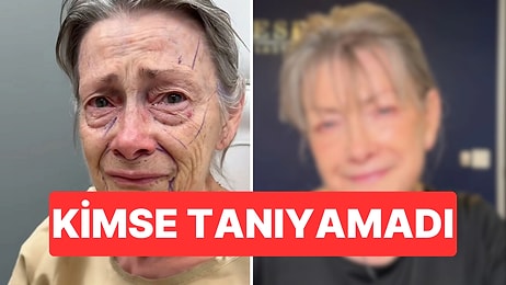 70 Yaşındaki Kadın Yüz Gerdirme Operasyonu Sonrası Gençliğine Geri Döndü