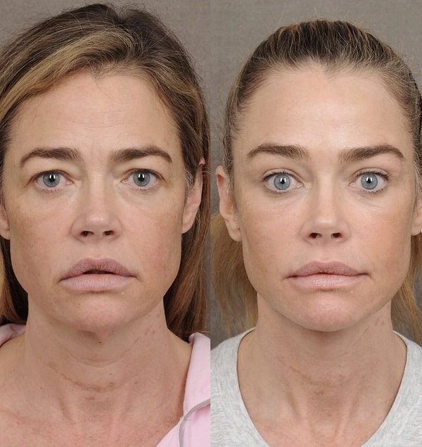 Denise Richards, a familiar name in Hollywood, is making headlines with the transformation she underwent following her cosmetic surgery.