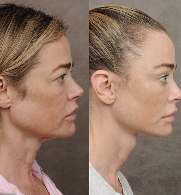 According to the statements of the plastic surgeon who performed the operation, multiple procedures such as a facelift, brow lift, and eyelid surgery were administered to Richards.
