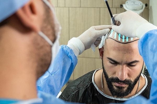 SSS: Saç Ekim Merkezleri Hakkında Merak Edilenler