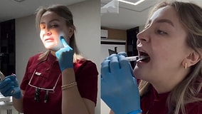 A Skilled Dentist Successfully Performs Their Own Wisdom Tooth Extraction With Precision