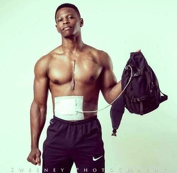 Yapay Kalple Vücut Geliştirmeye Devam Eden Sporcu