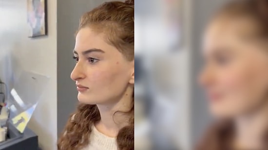 A Subtle Touch: This Woman’s Natural Rhinoplasty Transformation Is Winning Hearts Across Social Media