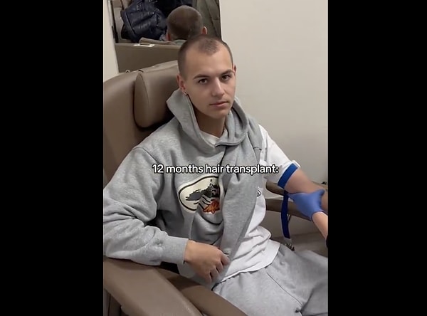 Peki saç ekimi için gerçekten bir yaş sınırı var mı?