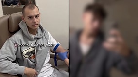 This Creator Traveled to Istanbul for a Hair Transplant and the Transformation Is Unreal! Before & After