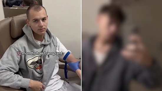 This Creator Traveled to Istanbul for a Hair Transplant and the Transformation Is Unreal! Before & After