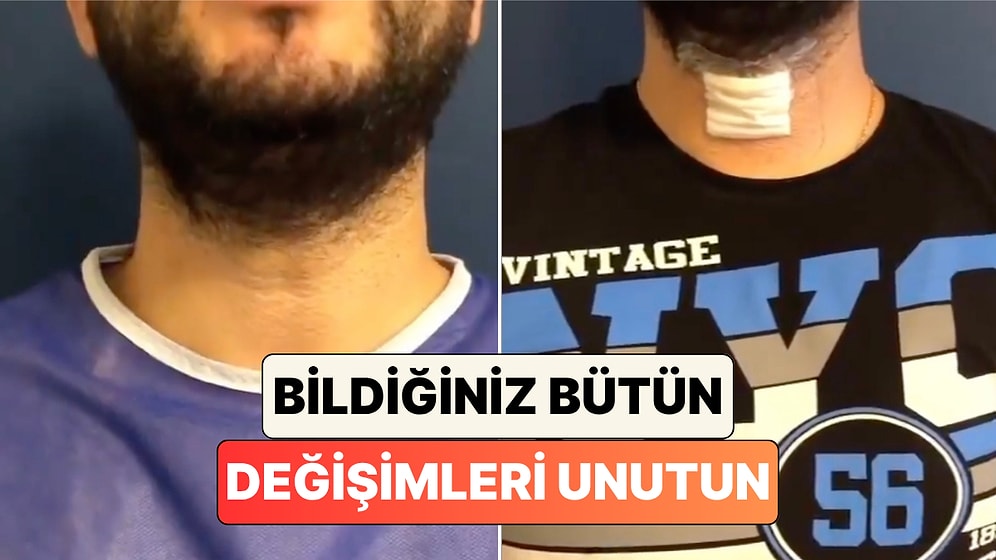 Ses Kalınlaştırma Operasyonu Geçiren Adamın Ses Tonunun Değişimi Viral Oldu