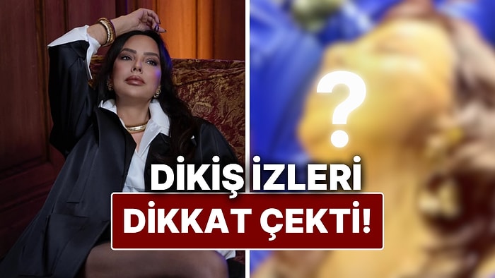 Ebru Gündeş'in Yarım Yüz Gerdirme Ameliyatı Sonrası Yüzündeki Dikiş İzleri Dikkat Çekti