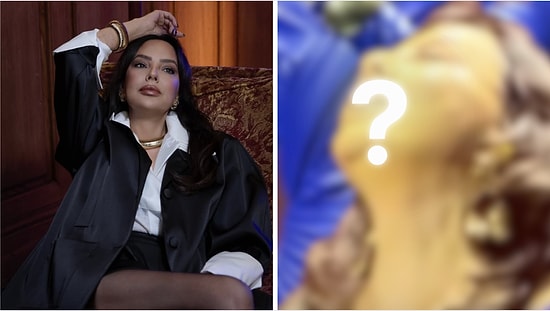 Stitch Marks on Ebru Gündeş’s Face Draw Attention After Half Facelift